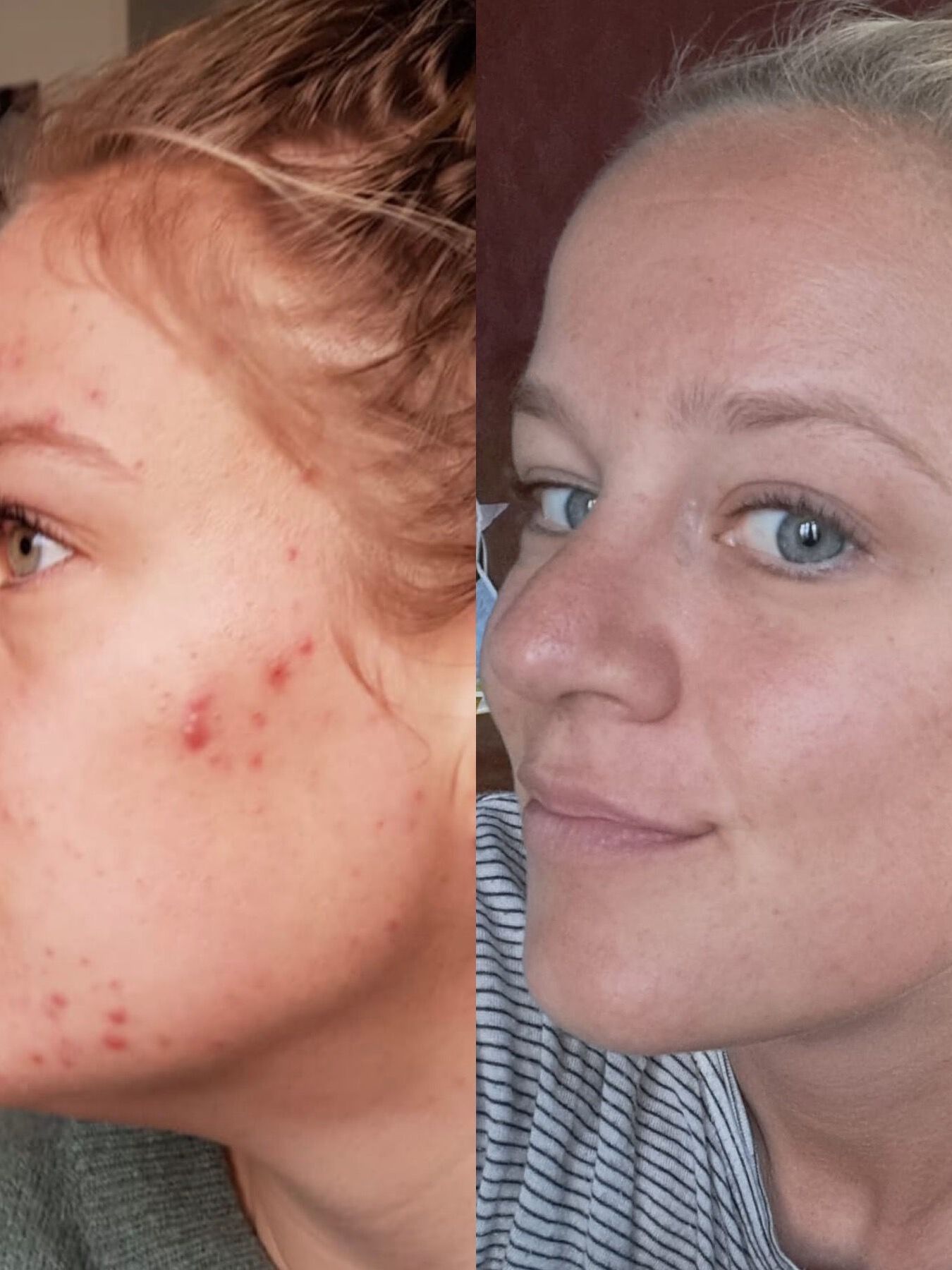 Voor en na microneedling van gelaat: links hormonale acne op kaaklijn, jukbeenderen en voorhoofd, rechts acne is onder controle en niet meer zichtbaar